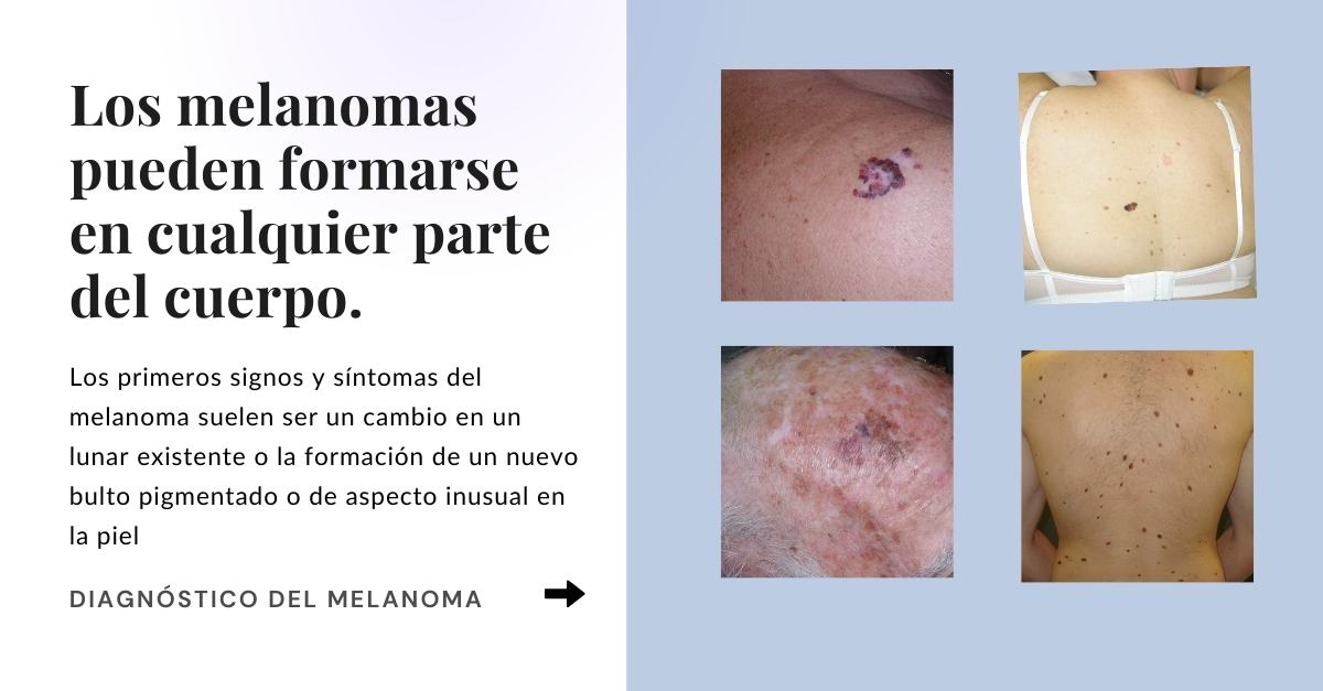 Melanoma fotos melanoma cuero cabelludo