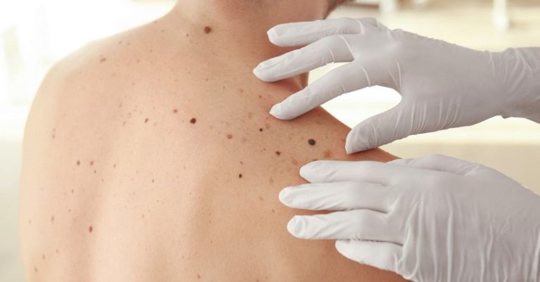 ¿Qué es melanoma ?